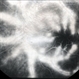 Frosted Branch Angiitis